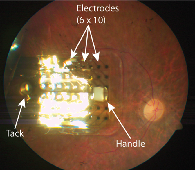 Photograph of an implanted Argus II retinal prosthesis (Second Sight Medical Products, Inc., Sylmar, CA) secured to the retina with a retinal tack. Humayun’s publication describing the clinical trial for this device ranks eighth amongst the most cited articles on pars plana vitrectomy ever published. 